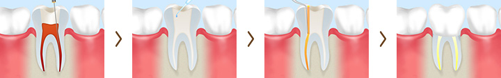 重度の虫歯を救う根管治療