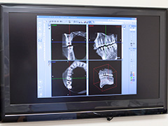 歯科用CTを用いた診断