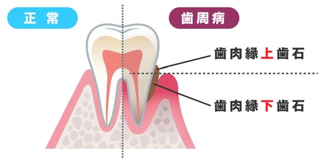 歯石について🦷