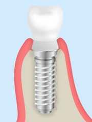 インプラント埋入