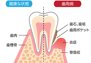 日本人の8割がかかっている 「歯周病」という病気