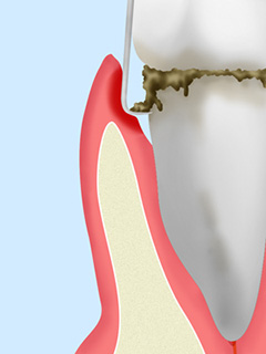 歯周ポケット掻爬（そうは）術
